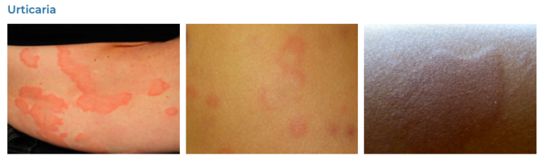 Annular Rash (Like Ringworm) - GP Exams